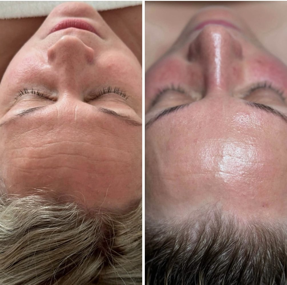 Before and after INOSSI Acne Treatment &mdash; side-by-side client photographs