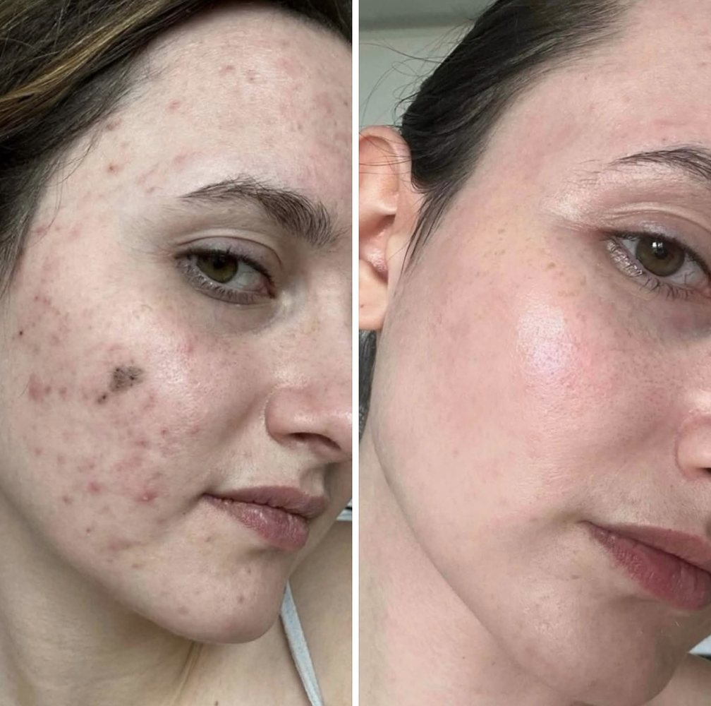 Before and after INOSSI Acne Treatment &mdash; side-by-side client photographs
