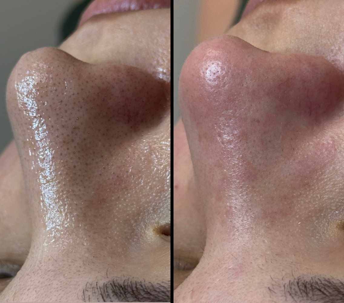 Before and after deep cleansing facial at INOSSI &mdash; nose area