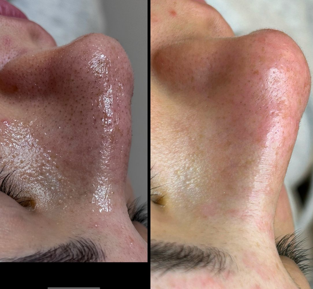 Before and after deep cleansing facial at INOSSI &mdash; side-by-side client photographs