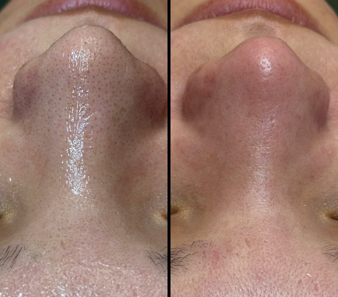 Before and after deep cleansing facial at INOSSI &mdash; side-by-side client photographs