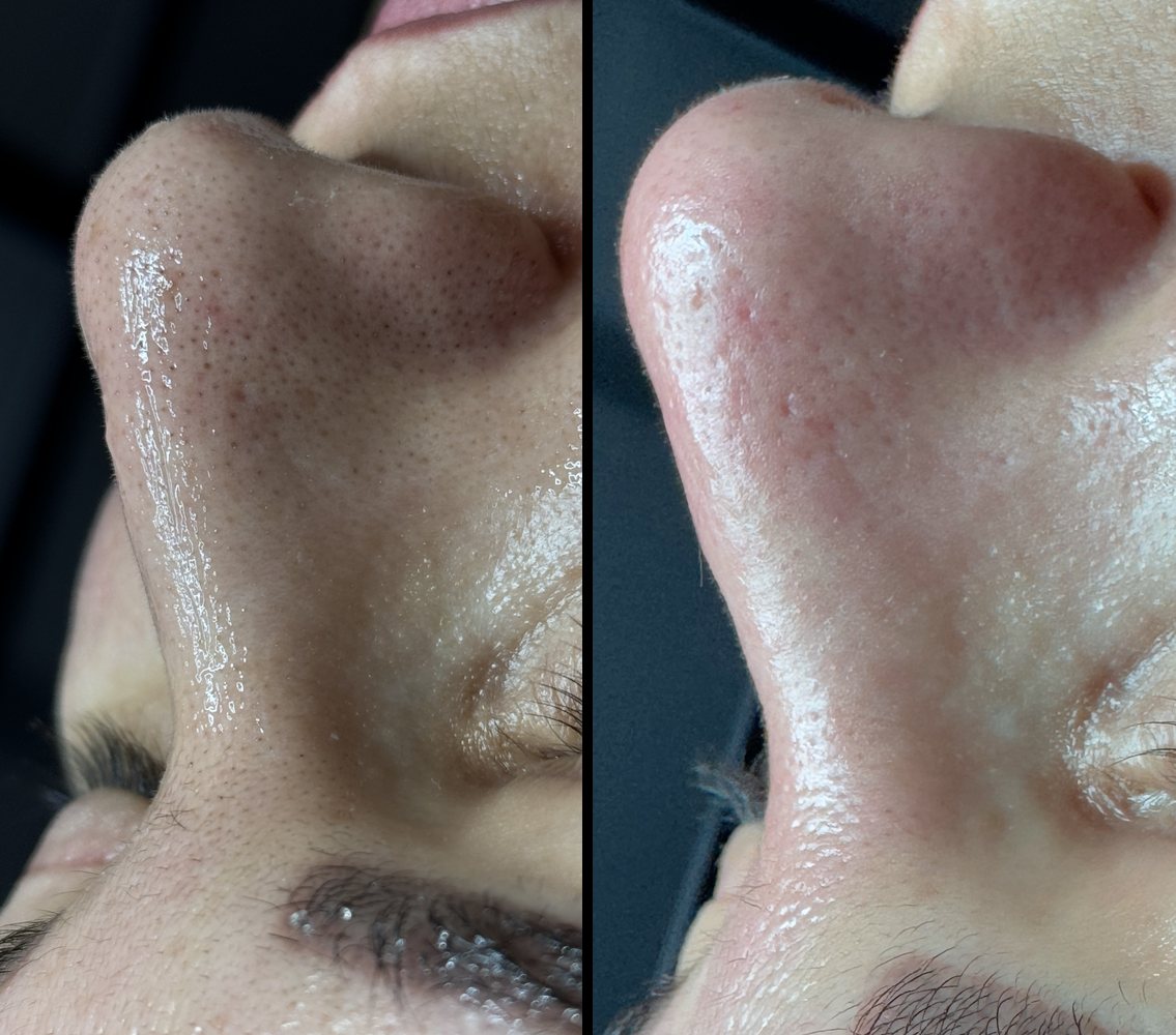 Before and after deep cleansing facial at INOSSI &mdash; side-by-side client photographs