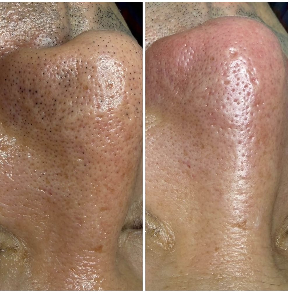 Before and after deep cleansing facial at INOSSI &mdash; side-by-side client photographs