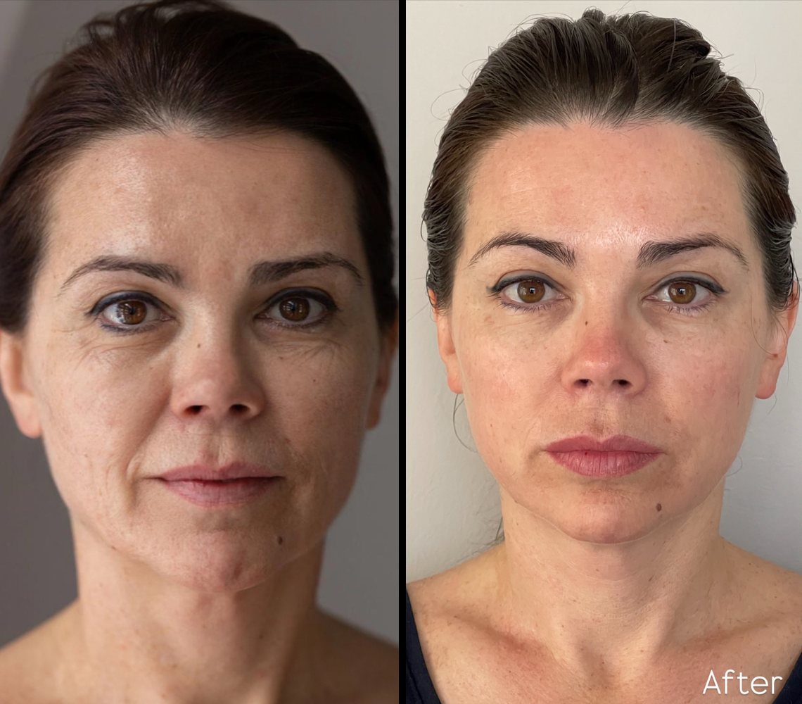 Before and after INOSSI Signature Facial Massage &mdash; side-by-side client photographs