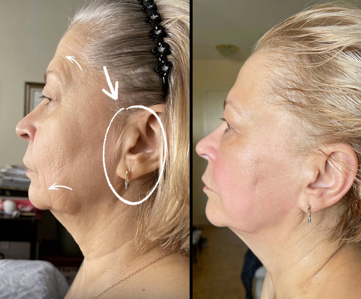 Before and after INOSSI Signature Facial Massage &mdash; jawline and neck in profile