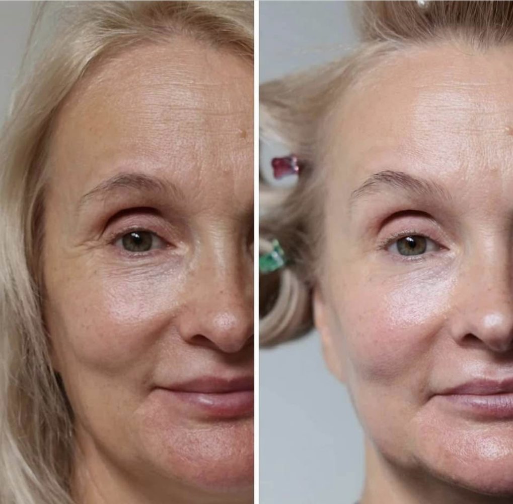 Before and after one INOSSI Lift Code session — side-by-side client photographs